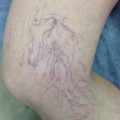 5 Ways Spider Veins Harm